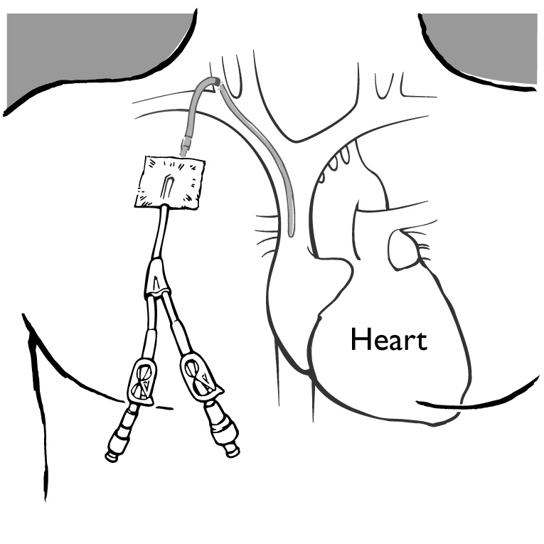 hickman catheter Can you take ondansetron with amoxicillin hickman catheter Can you take ondansetron with amoxicillin
